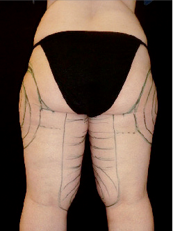 Präoperative gekennzeichnete Absaugareale Präoperative gekennzeichnete Absaugareale